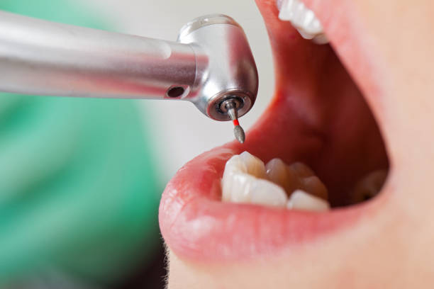 Best Emergency Wisdom Teeth Removal in West Linn, OR
